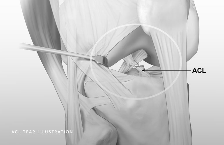 ACL-Tear-Illustration